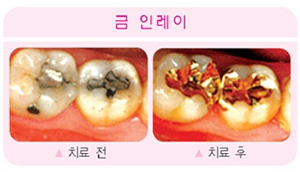 금 인레이