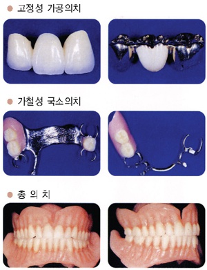 고정성 가공의치, 가철성 국소의치, 총의치