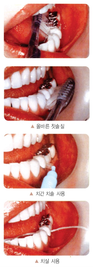 올바른 칫솔질, 치간치솔사용, 치실사용