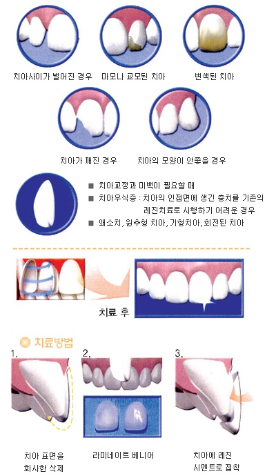 라미네이트 치료가 필요한 경우